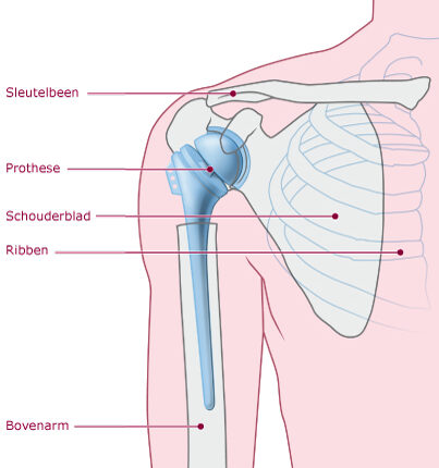 schouderprothese